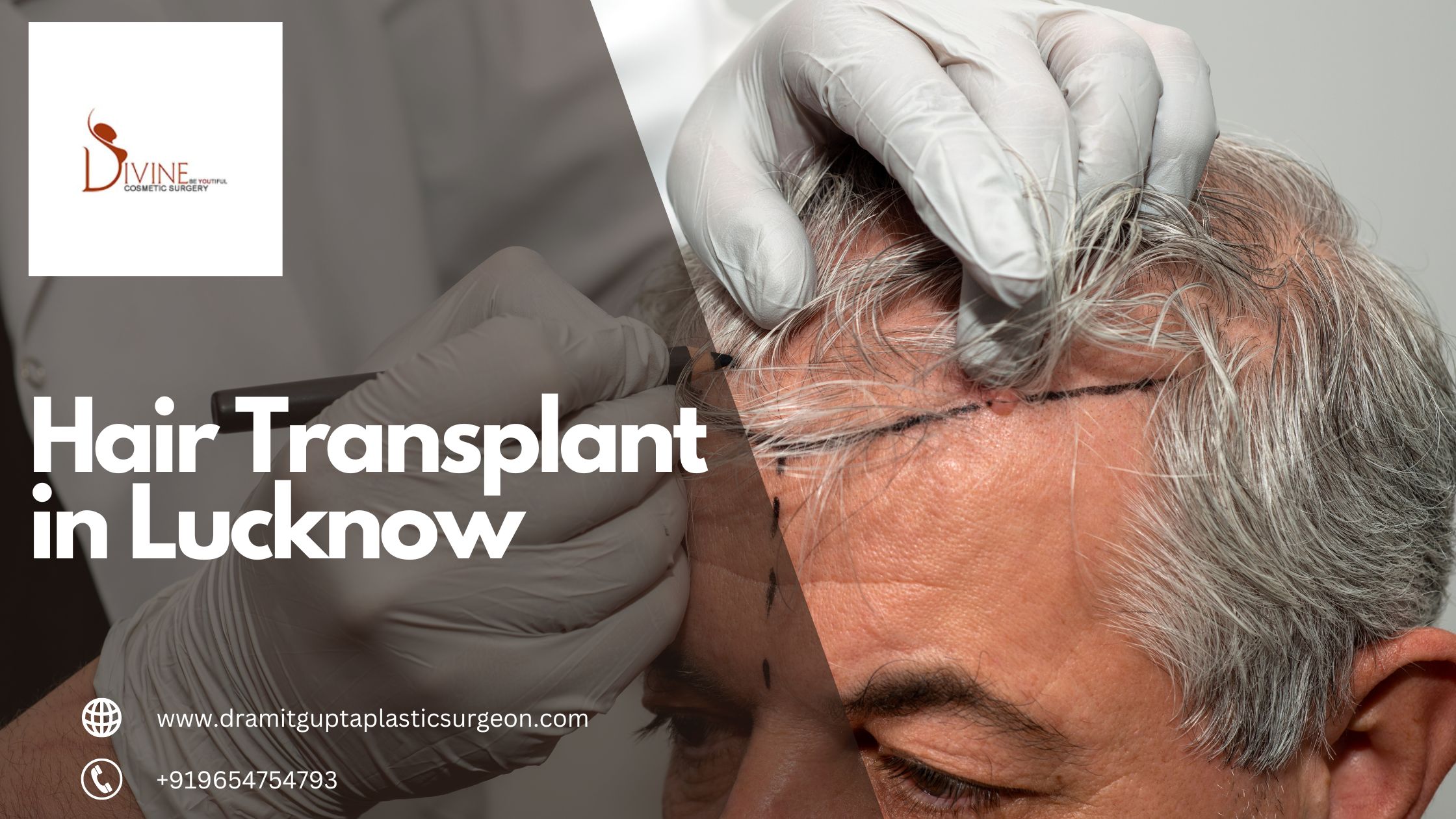 Step-by-Step Guide to a Hair Transplant in Lucknow