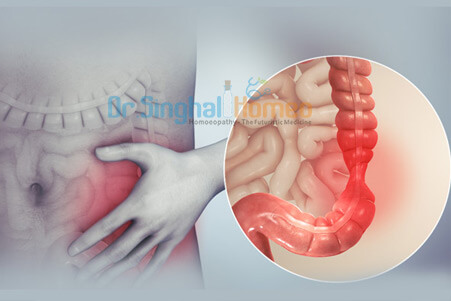 Homeopathic Treatment for IBS | Homeopathy for IBS