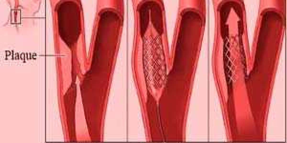 Advanced Angioplasty Treatment in Mumbai: Your Path to a Healthier Heart