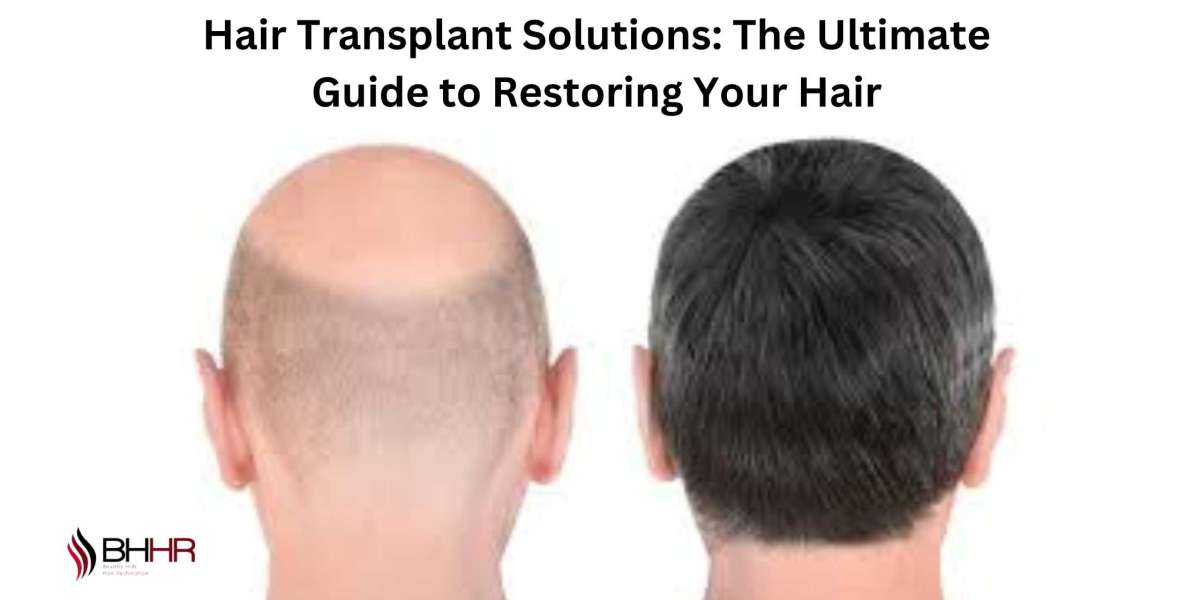 Hair Transplant Solutions: The Ultimate Guide to Restoring Your Hair
