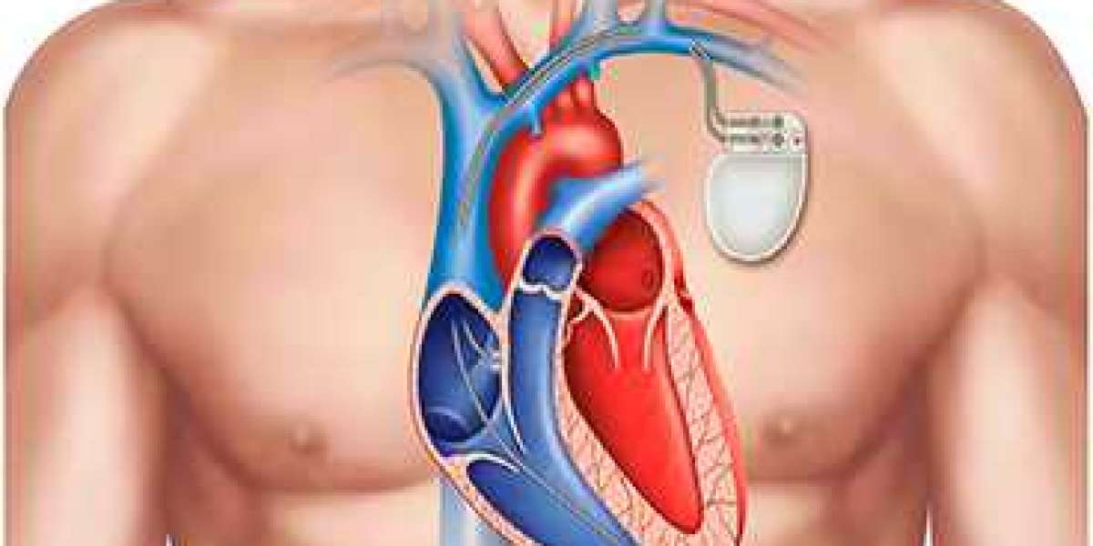 Pacemaker Implantation in Chennai: Enhancing Heart Health with Advanced Care