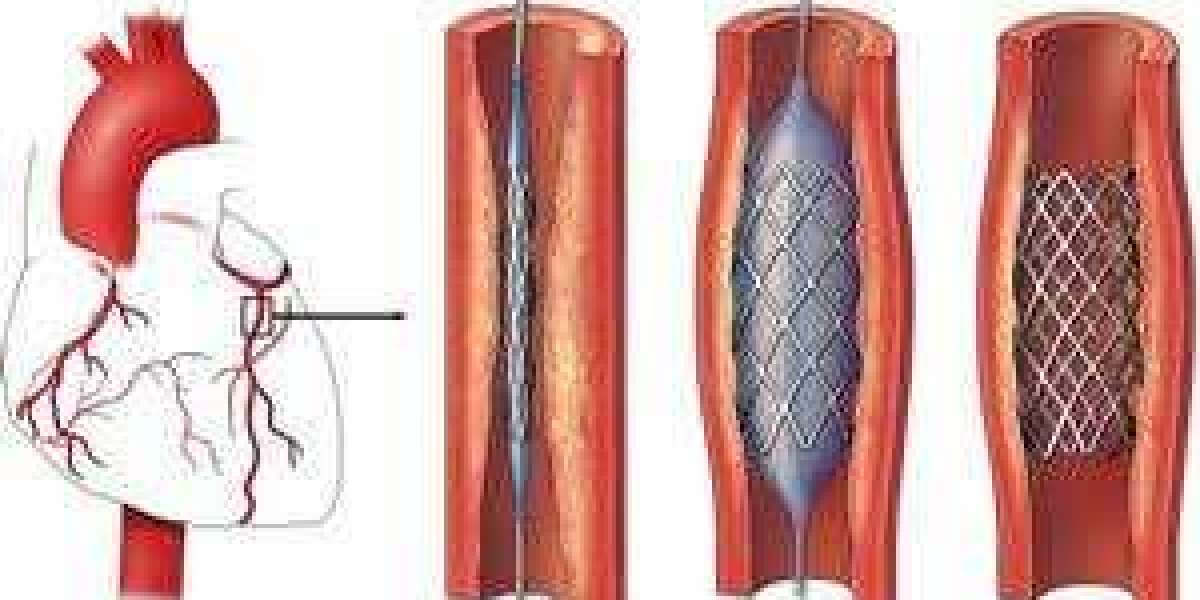 Top-Quality Angioplasty Treatment in Chennai: A Guide to Heart Health