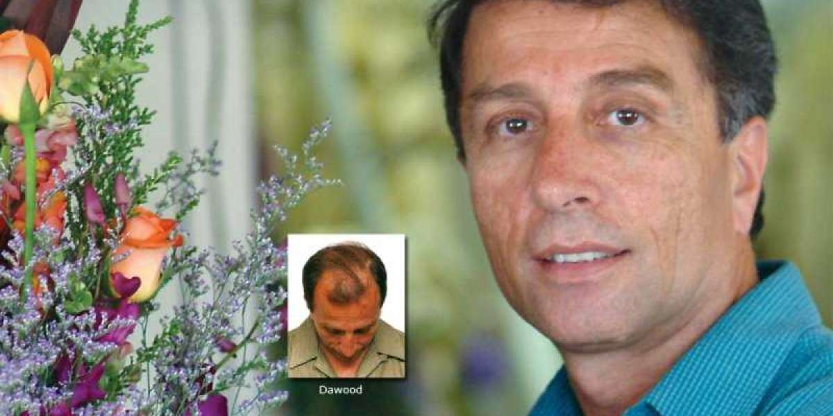 Treat Hair Loss  Restore Your Confidence with PRP in Lahore