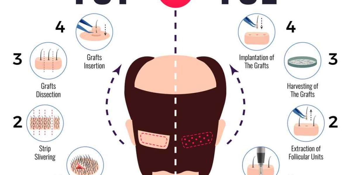 FUE vs. FUT: Choosing the Right Hair Transplant in Delhi NCR